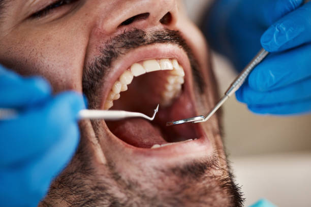 Best Emergency Root Canal Treatment in Palm Springs, FL