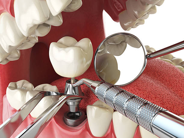 Best Emergency Treatment for Toothache in Palm Springs, FL